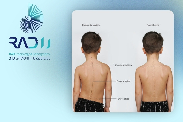 سایر روش‌های تشخیص انحراف ستون فقرات