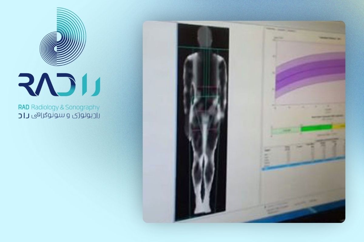 چه کسانی نیاز بیشتری به سنجش تراکم استخوان دارند؟