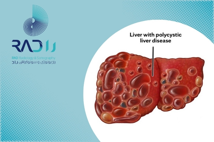آیا بیماری کبد پلی‌کیستیک نیاز به درمان دارد یا فقط پیگیری کافی است؟