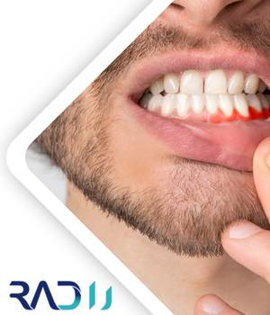 تشخیص عفونت از روی تصاویر دندان تشخیص عفونت از روی تصاویر دندان