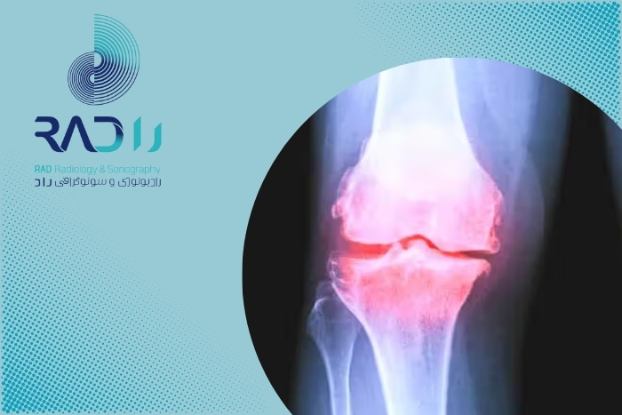 آیا رادیوگرافی ساده می‌تواند آرتروز اولیه را تشخیص دهد؟