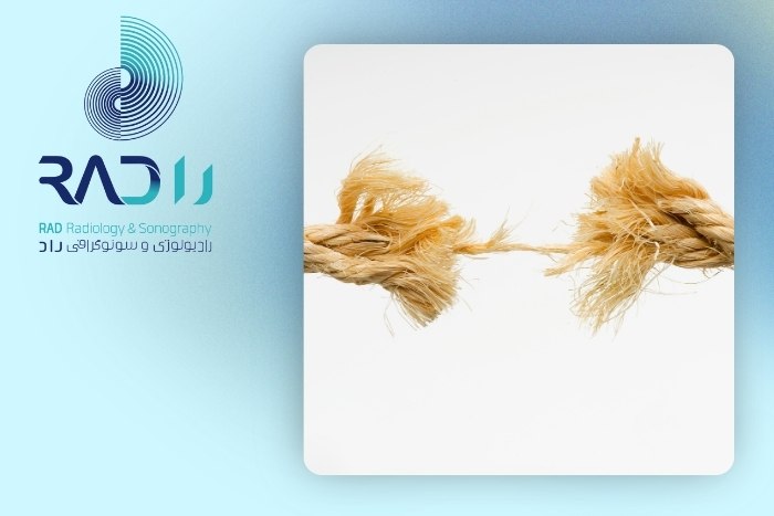 انواع پارگی تاندون شانه انواع پارگی تاندون شانه