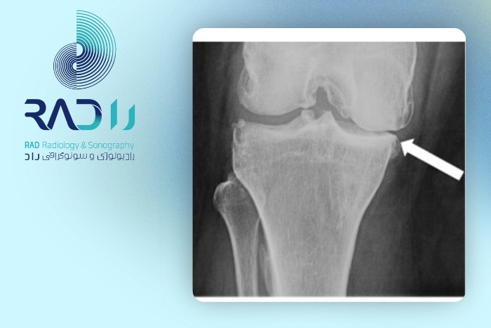 تشخیص آرتروز اولیه با رادیوگرافی ساده تشخیص آرتروز اولیه با رادیوگرافی ساده