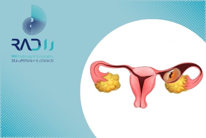 حاملگی خارج رحمی چه علائمی دارد و چگونه می توان آن را تشخیص داد؟