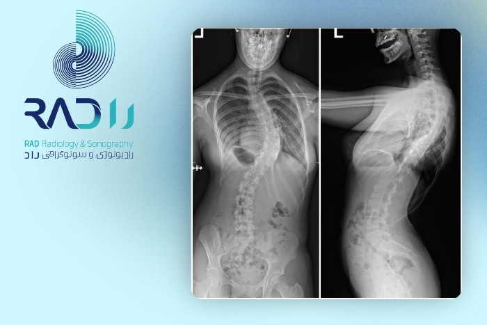 دقت رادیوگرافی ستون فقرات در تشخیص اسکولیوز