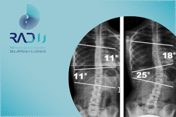 رادیوگرافی ستون فقرات در تشخیص اسکولیوز چقدر دقیق است؟