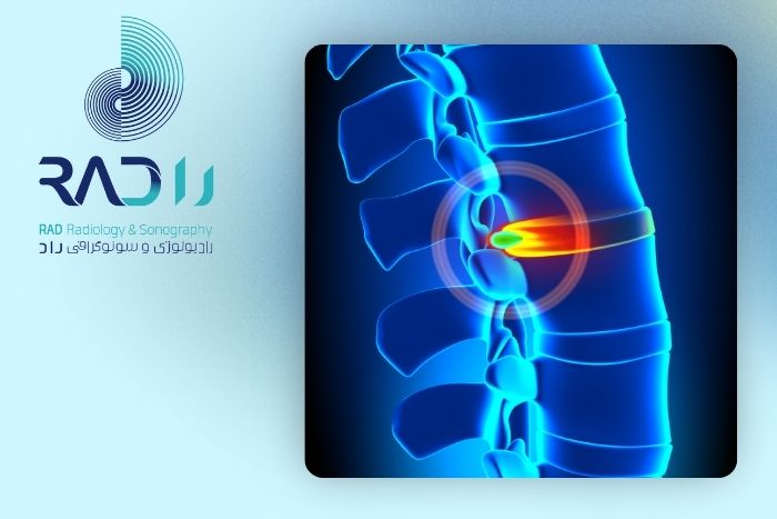 روش های پیشگیری از ایجاد فتق دیسک کمر