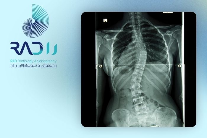 علائم بروز اسکولیوز