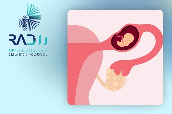 علائم حاملگی خارج رحمی