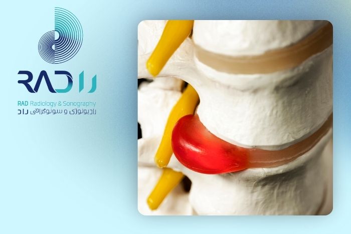 علل ایجاد فتق دیسک کمر علل ایجاد فتق دیسک کمر