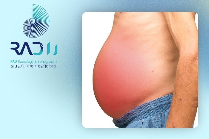 علل تجمع آب در شکم