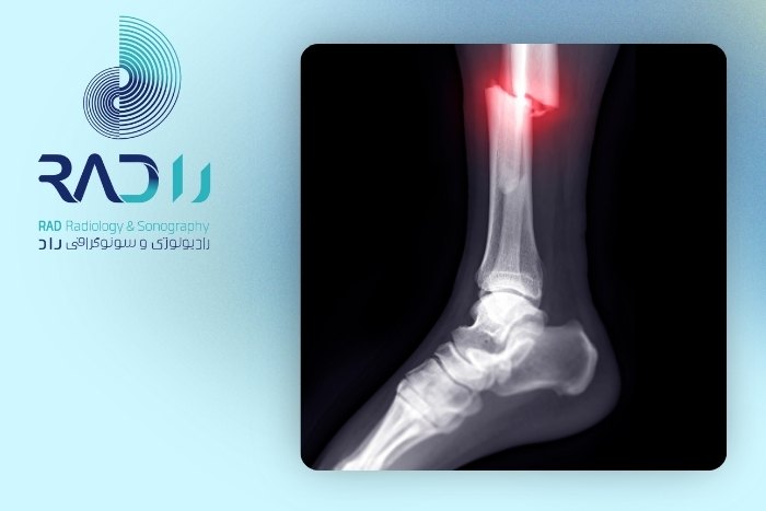 عوامل موثر بر ترمیم استخوان