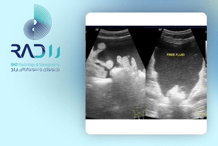 نقش سونوگرافی در شناسایی وجود آب در شکم (آسیت)
