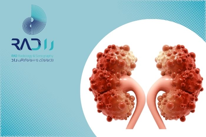 چرا برخی از کیست‌های کلیه نیاز به پیگیری دارند؟
