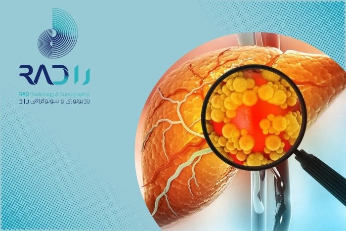 چگونه می‌توان شدت فیبروز کبدی را بدون جراحی سنجید؟