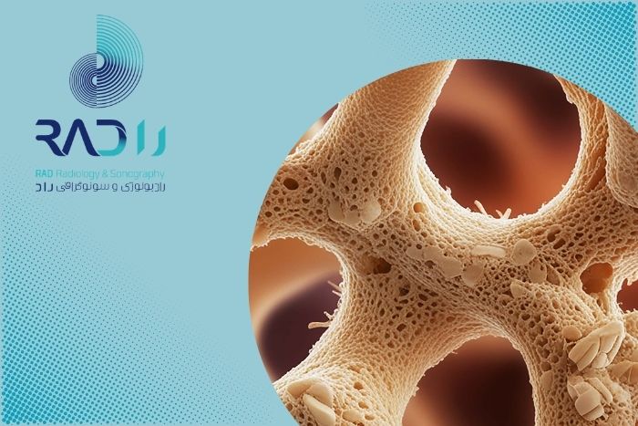 چه بیماریهایی باعث کاهش تراکم استخوان میشوند؟ چه بیماریهایی باعث کاهش تراکم استخوان میشوند؟