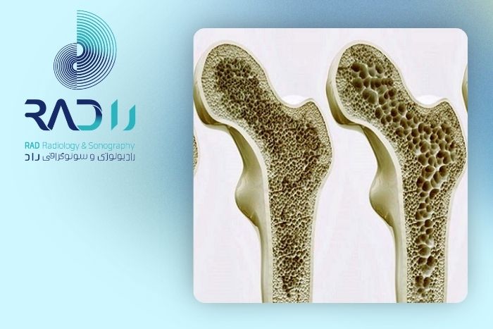 چه بیماریهایی باعث کاهش تراکم استخوان میشوند؟ چه بیماریهایی باعث کاهش تراکم استخوان میشوند؟