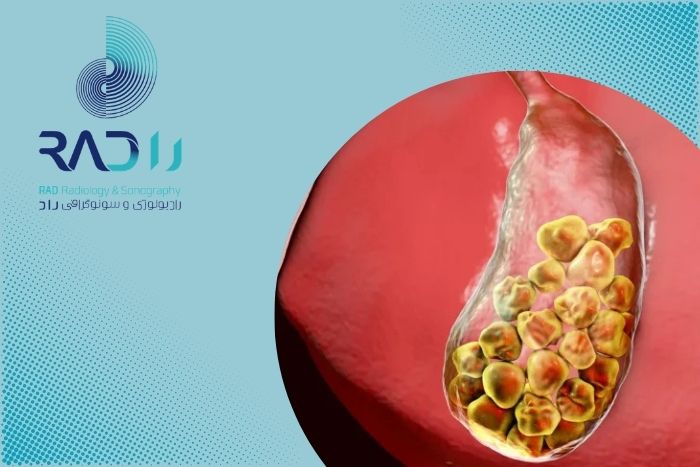 سنگ کیسه صفرا چه علائمی دارد و چگونه تشخیص داده میشود؟ سنگ کیسه صفرا چه علائمی دارد و چگونه تشخیص داده میشود؟