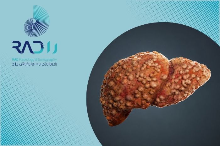 آیا بیماری کبد همیشه با علامت همراه است؟ آیا بیماری کبد همیشه با علامت همراه است؟