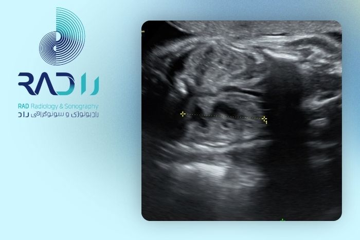 اندازه بی‌خطر پیلکتازی چند میلی‌متر است؟