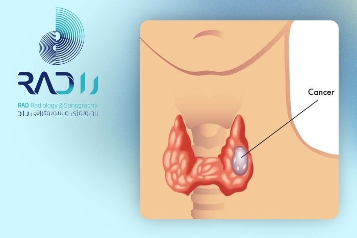 انواع کنسر تیروئید و احتمال بازگشت انواع کنسر تیروئید و احتمال بازگشت