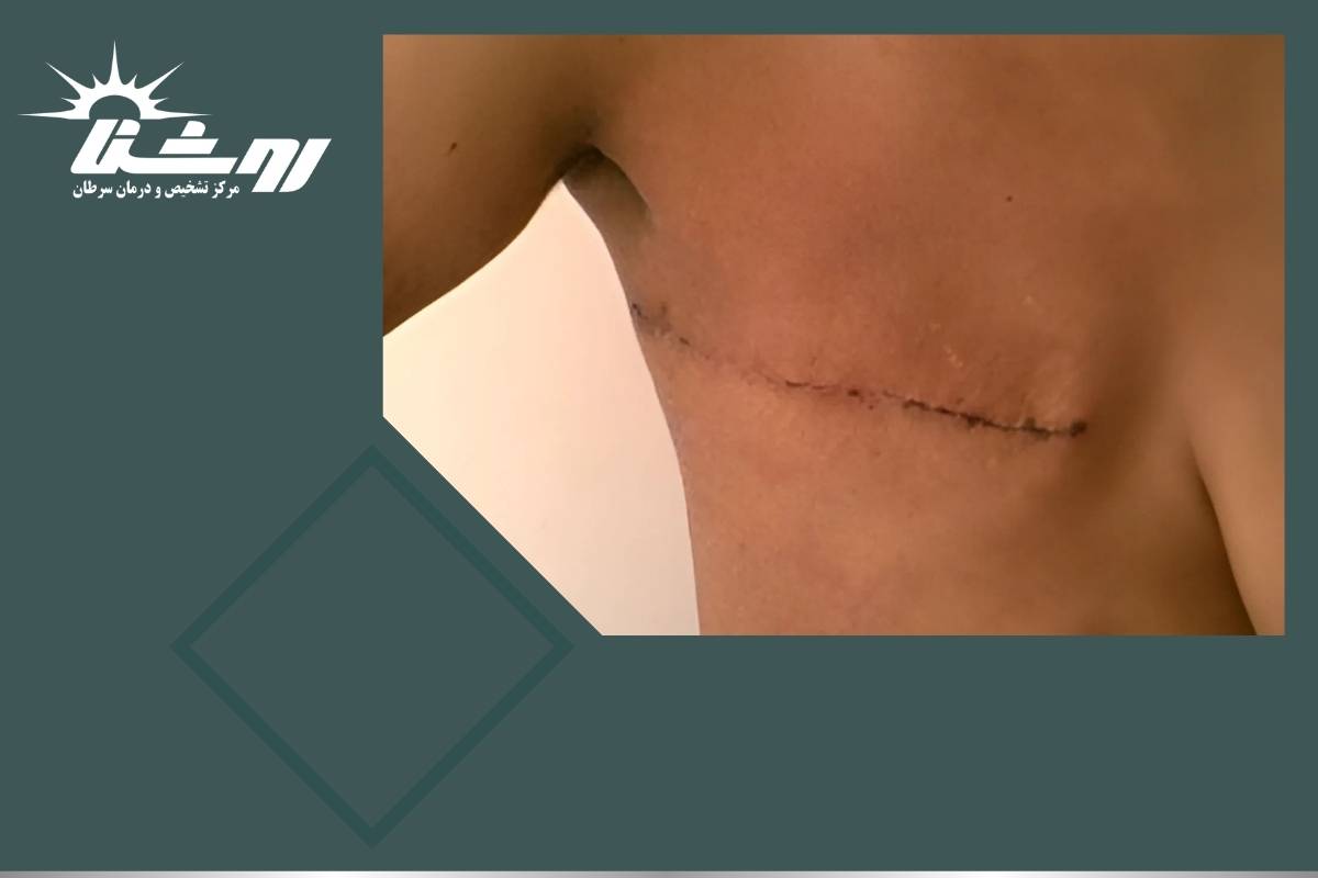 سرطان سینه از چه سنی شروع می شود؟