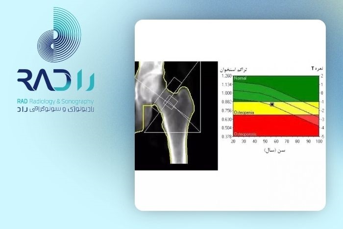 تفاوت T-Score و Z-Score در برگه سنجش تراکم استخوان