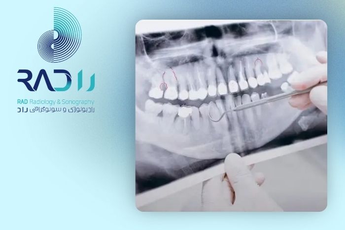 علائم عفونت ریشه دندان علائم عفونت ریشه دندان