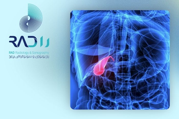 علت اصلی تشکیل سنگ در کیسه صفرا علت اصلی تشکیل سنگ در کیسه صفرا