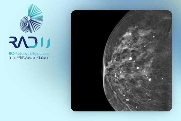 میکروکلسیفیکاسیون در ماموگرافی چه معنایی دارد؟