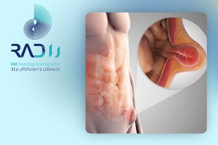 چه بیماری‌هایی با فتق اینگوینال اشتباه گرفته می‌شوند؟